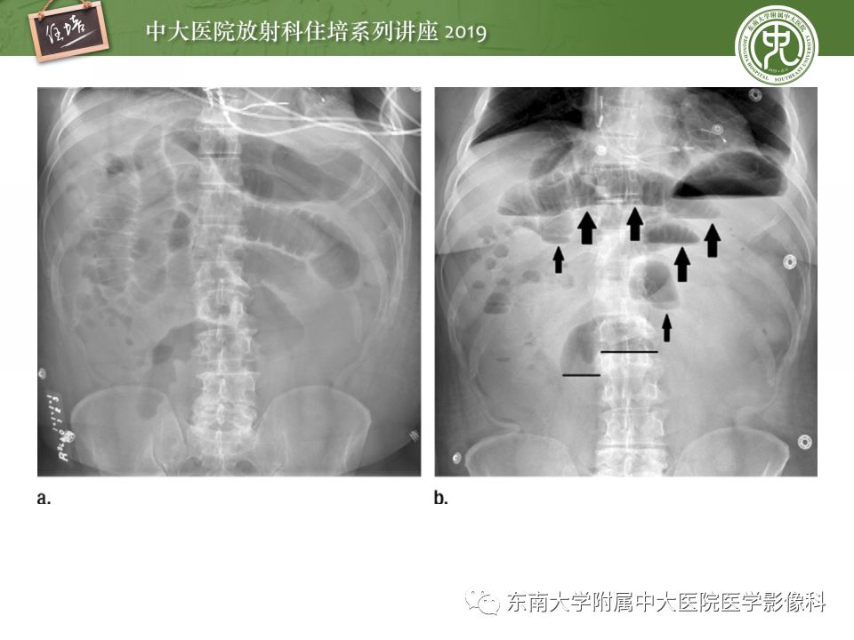 【PPT】小肠梗阻的影像分析及诊断