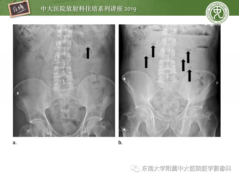 【PPT】小肠梗阻的影像分析及诊断