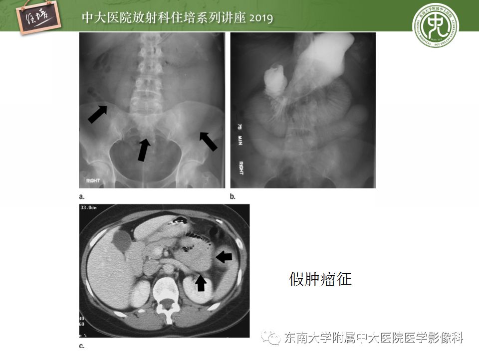 【PPT】小肠梗阻的影像分析及诊断