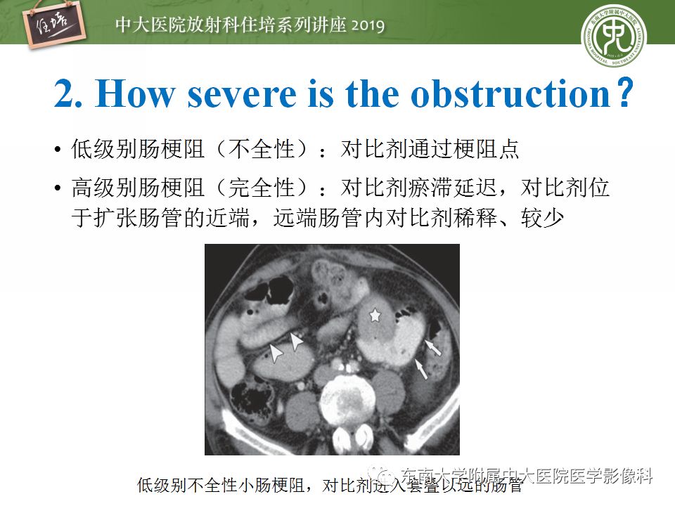 【PPT】小肠梗阻的影像分析及诊断