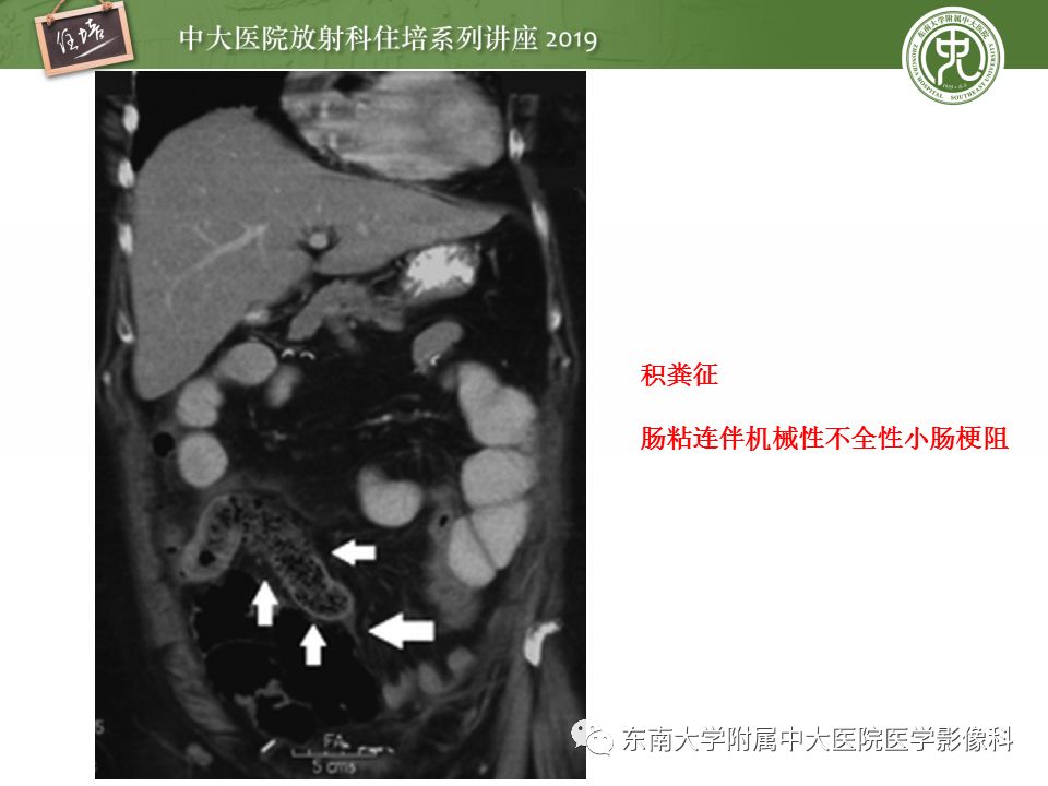 【PPT】小肠梗阻的影像分析及诊断