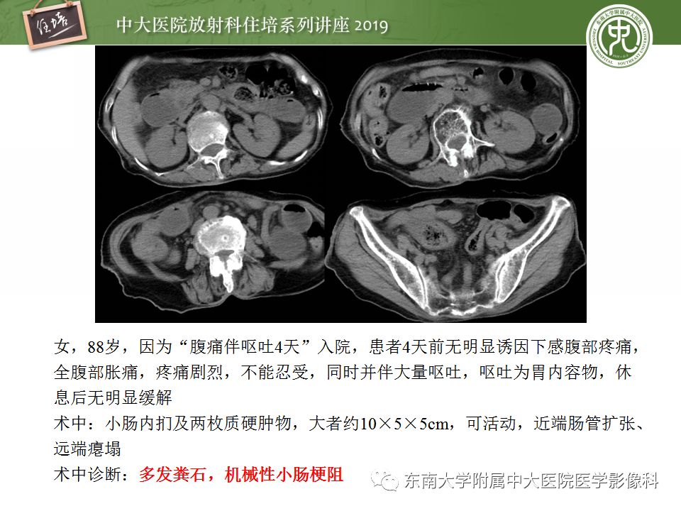 【PPT】小肠梗阻的影像分析及诊断