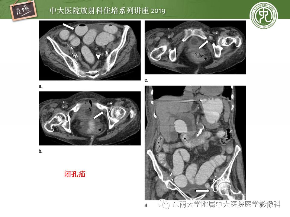 【PPT】小肠梗阻的影像分析及诊断