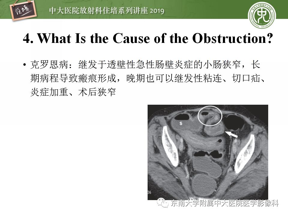 【PPT】小肠梗阻的影像分析及诊断