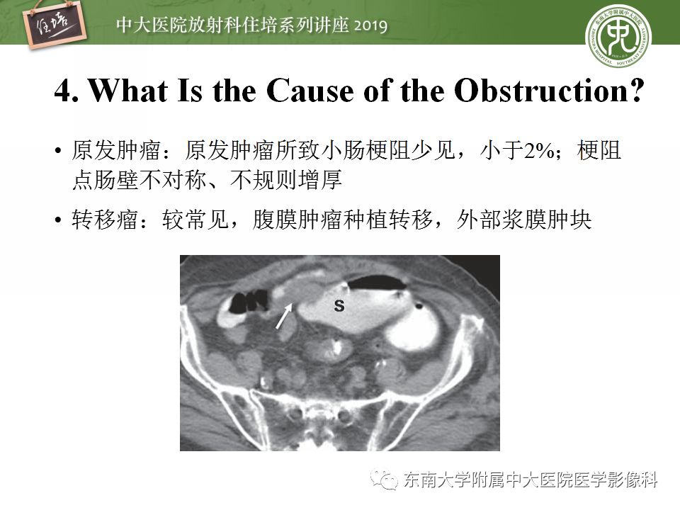 【PPT】小肠梗阻的影像分析及诊断