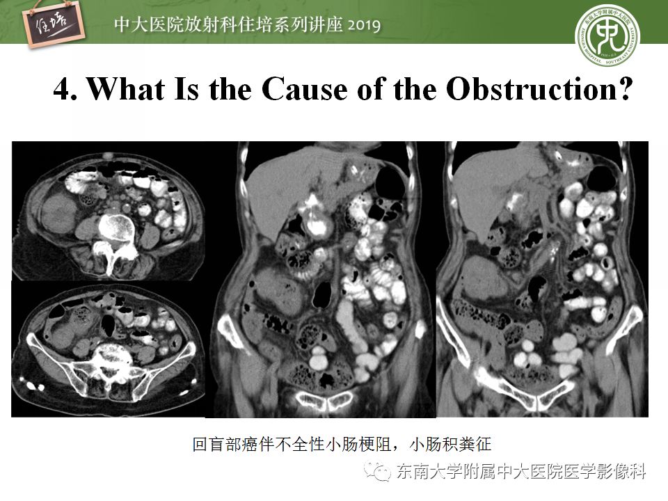 【PPT】小肠梗阻的影像分析及诊断