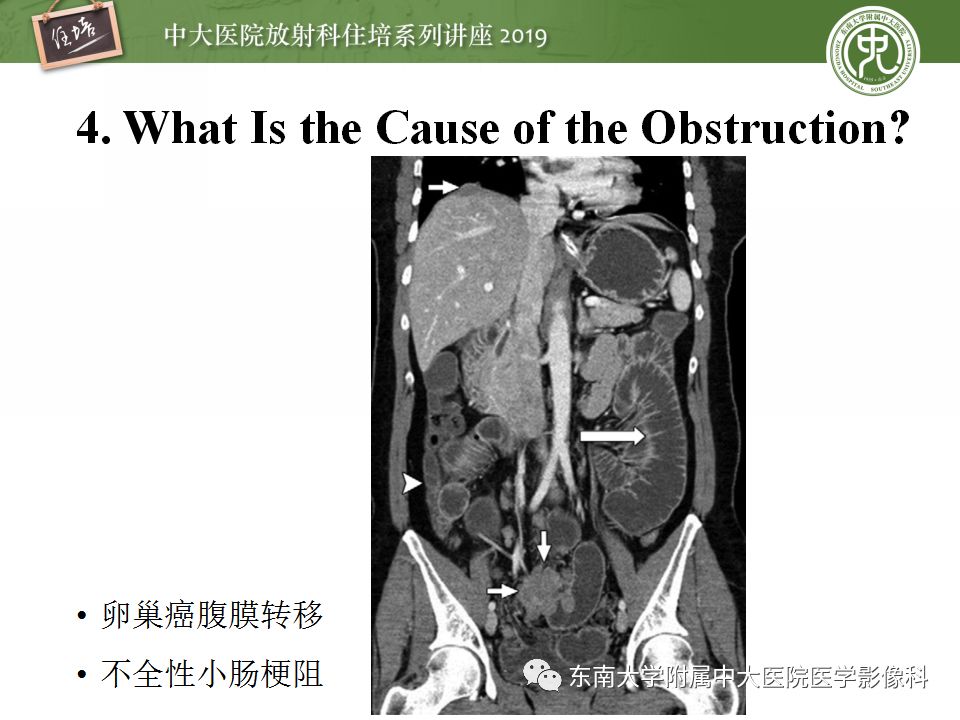【PPT】小肠梗阻的影像分析及诊断