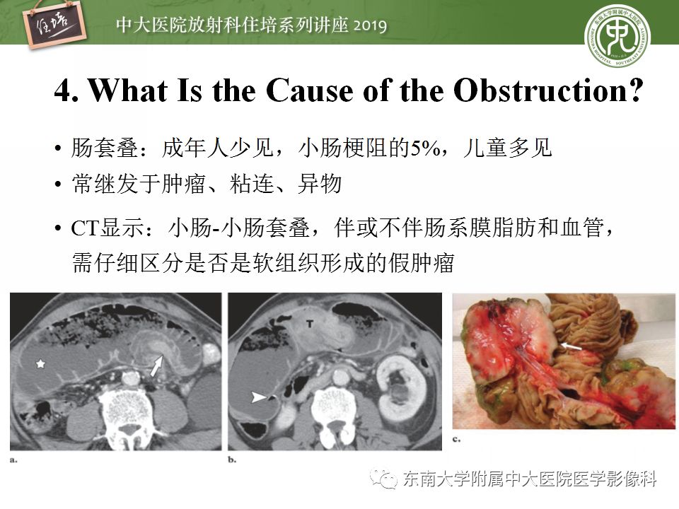 【PPT】小肠梗阻的影像分析及诊断