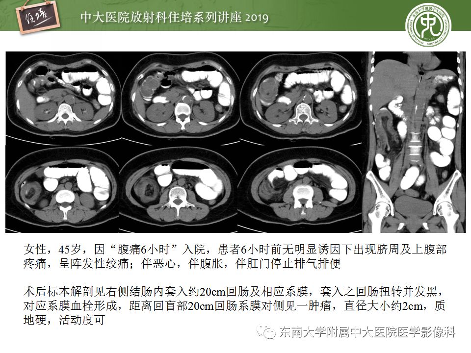 【PPT】小肠梗阻的影像分析及诊断