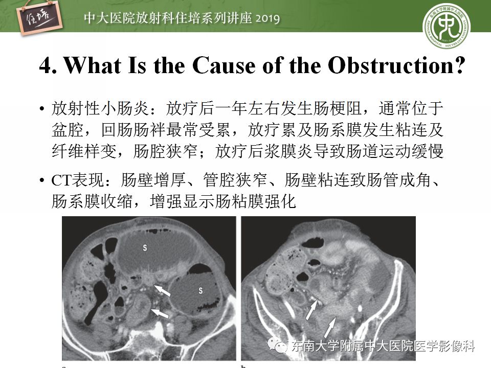 【PPT】小肠梗阻的影像分析及诊断