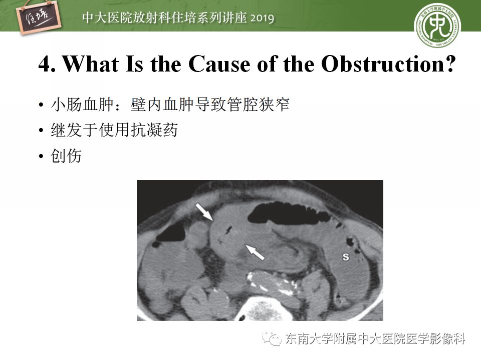 【PPT】小肠梗阻的影像分析及诊断