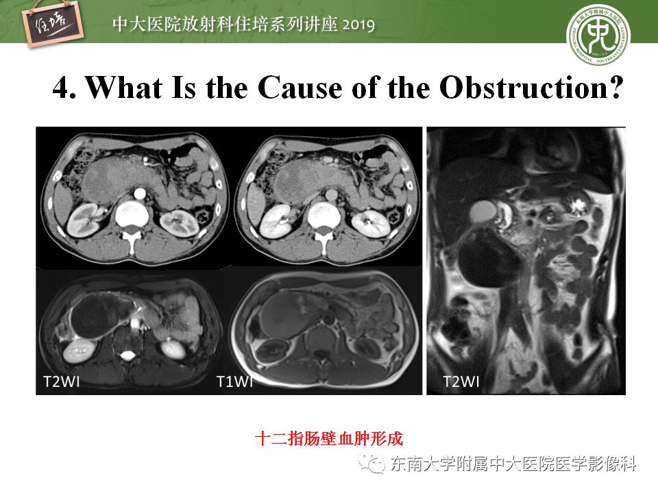 【PPT】小肠梗阻的影像分析及诊断