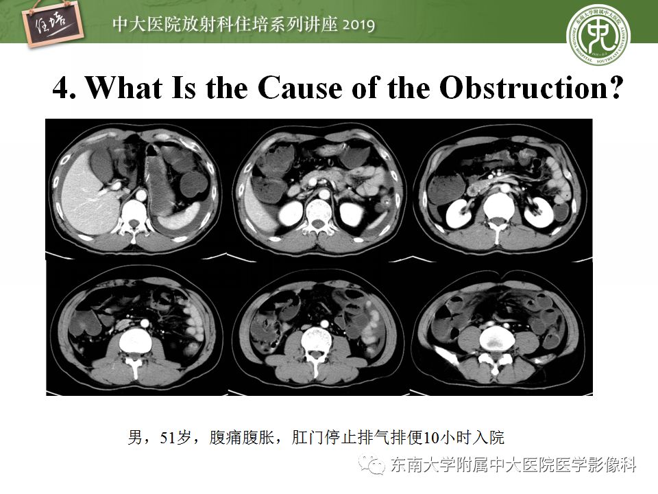 【PPT】小肠梗阻的影像分析及诊断
