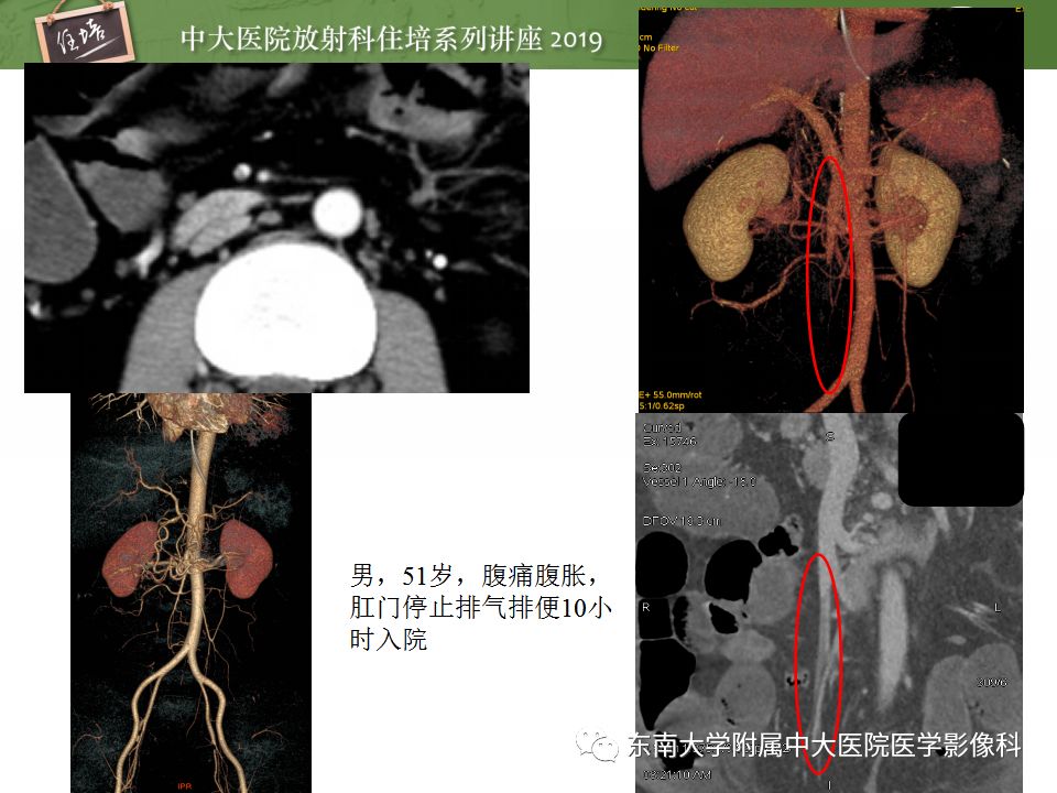 【PPT】小肠梗阻的影像分析及诊断