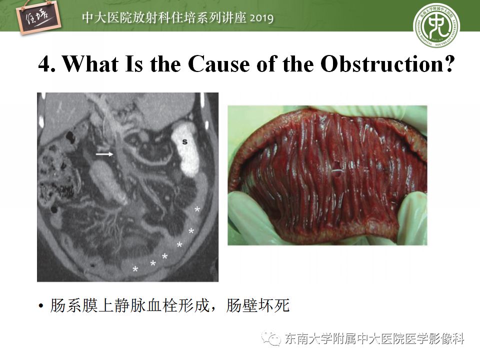 【PPT】小肠梗阻的影像分析及诊断