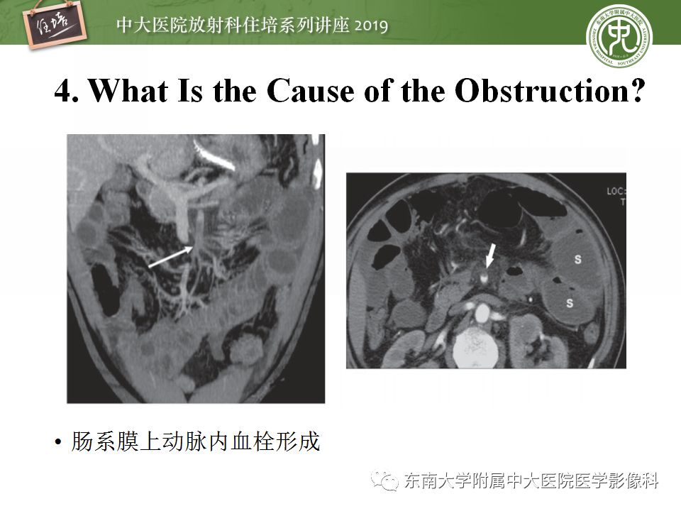 【PPT】小肠梗阻的影像分析及诊断