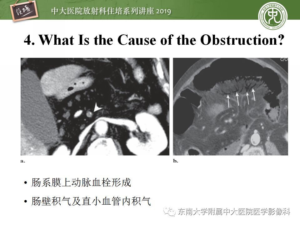 【PPT】小肠梗阻的影像分析及诊断