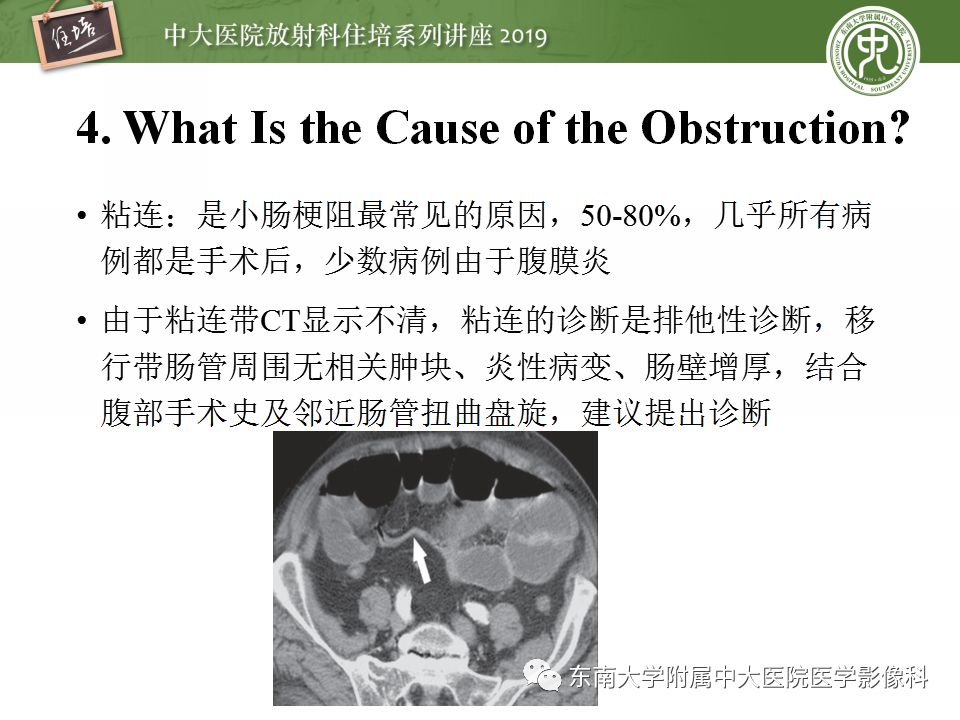 【PPT】小肠梗阻的影像分析及诊断