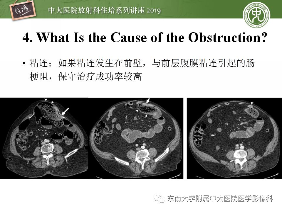 【PPT】小肠梗阻的影像分析及诊断