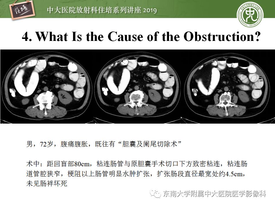 【PPT】小肠梗阻的影像分析及诊断