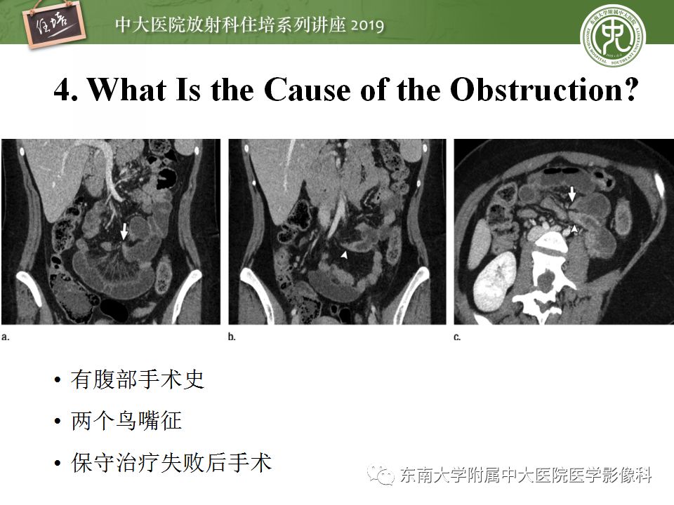 【PPT】小肠梗阻的影像分析及诊断