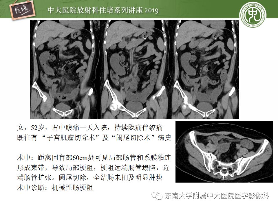 【PPT】小肠梗阻的影像分析及诊断