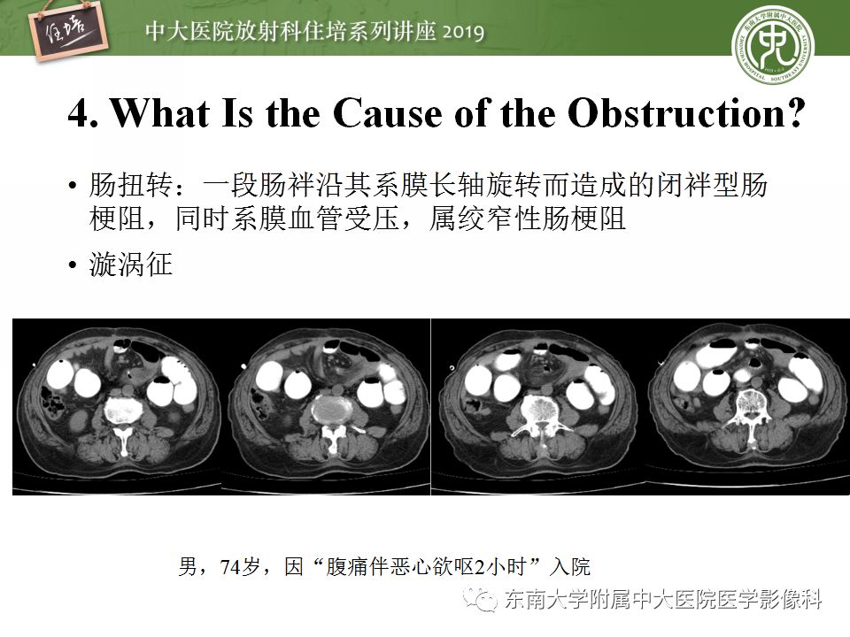 【PPT】小肠梗阻的影像分析及诊断