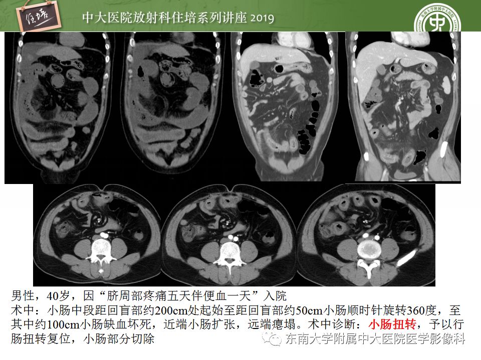 【PPT】小肠梗阻的影像分析及诊断
