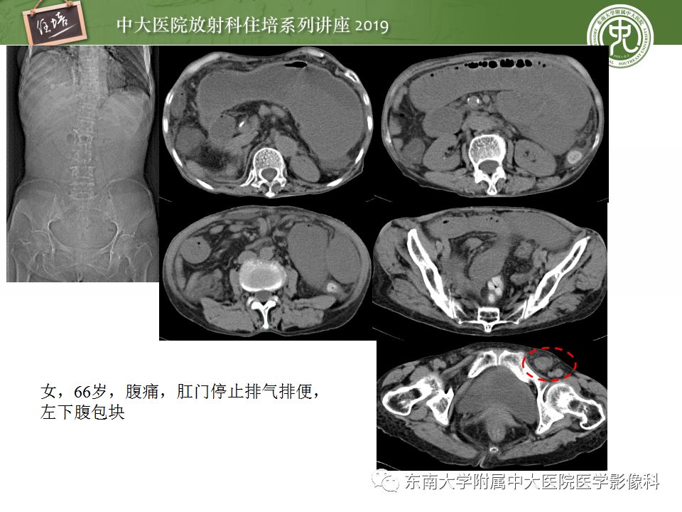 【PPT】小肠梗阻的影像分析及诊断