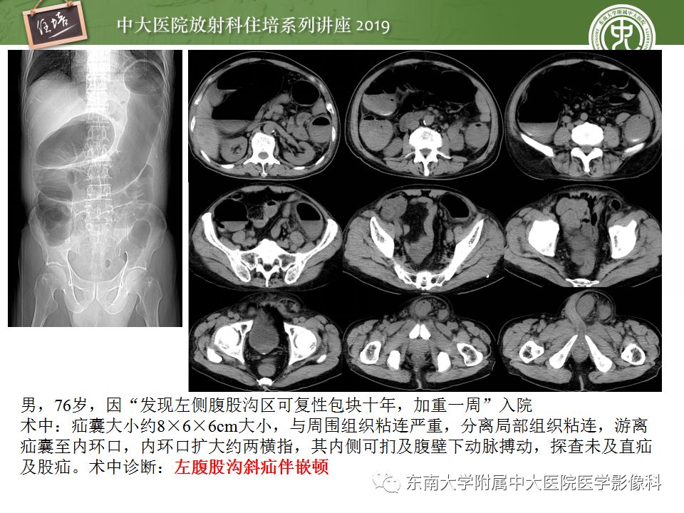 【PPT】小肠梗阻的影像分析及诊断