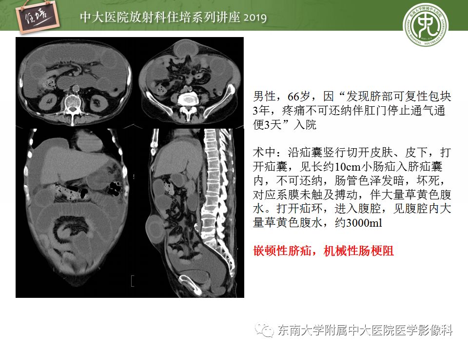 【PPT】小肠梗阻的影像分析及诊断