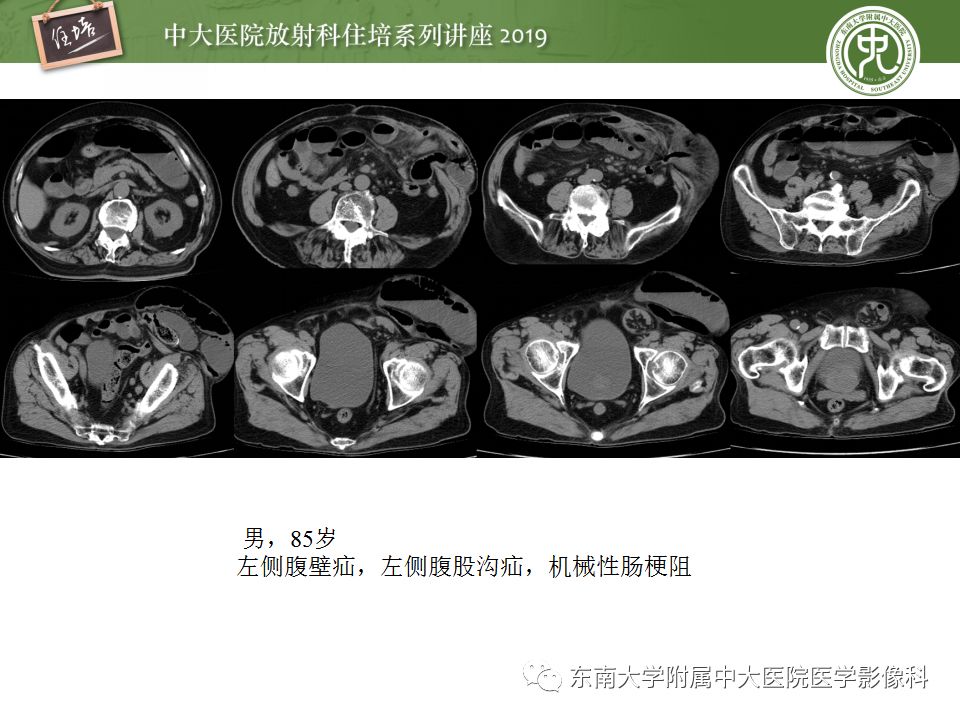 【PPT】小肠梗阻的影像分析及诊断
