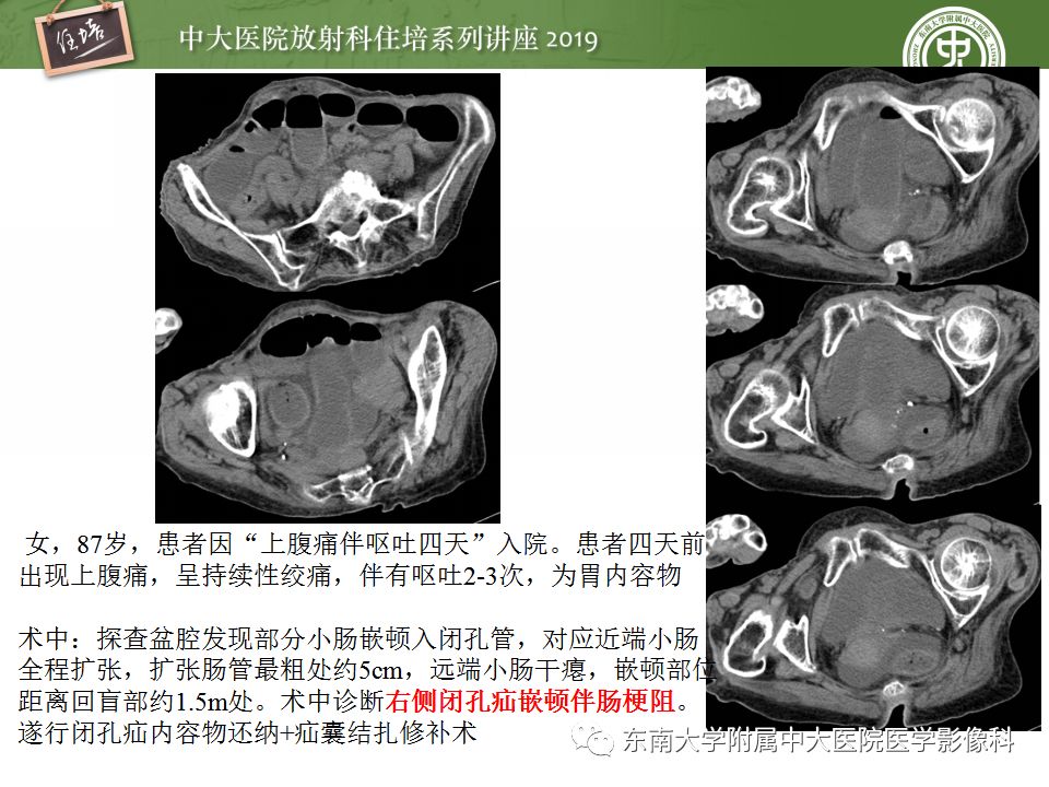 【PPT】小肠梗阻的影像分析及诊断
