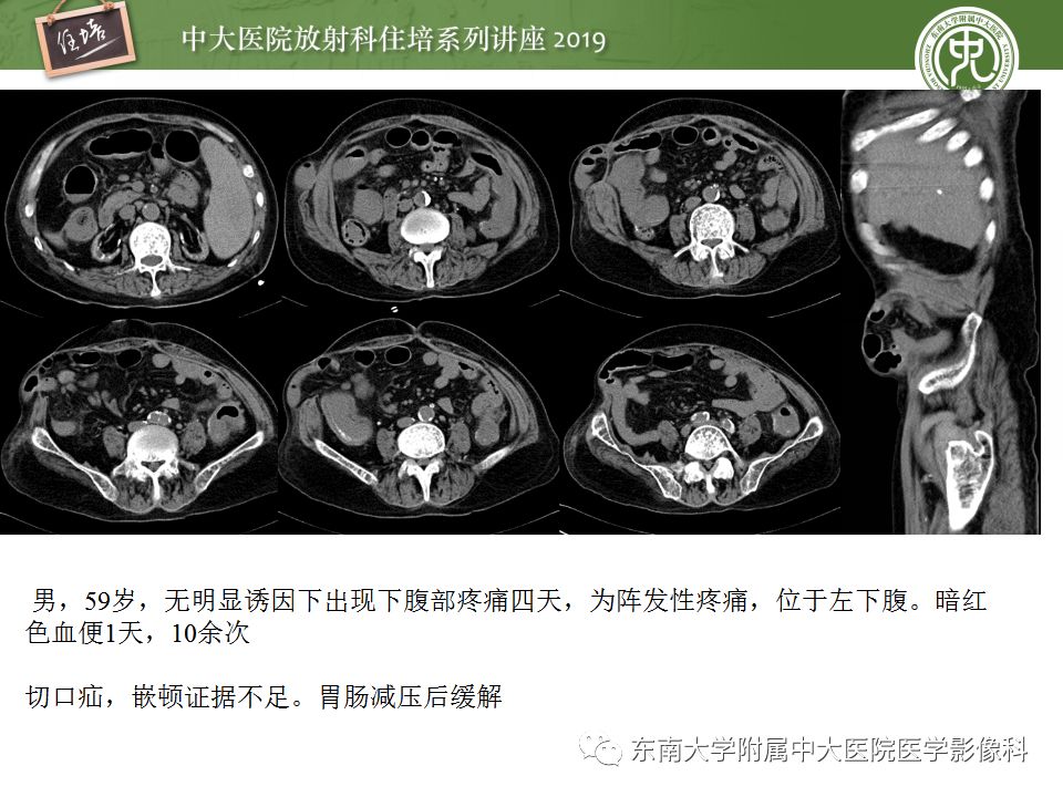 【PPT】小肠梗阻的影像分析及诊断