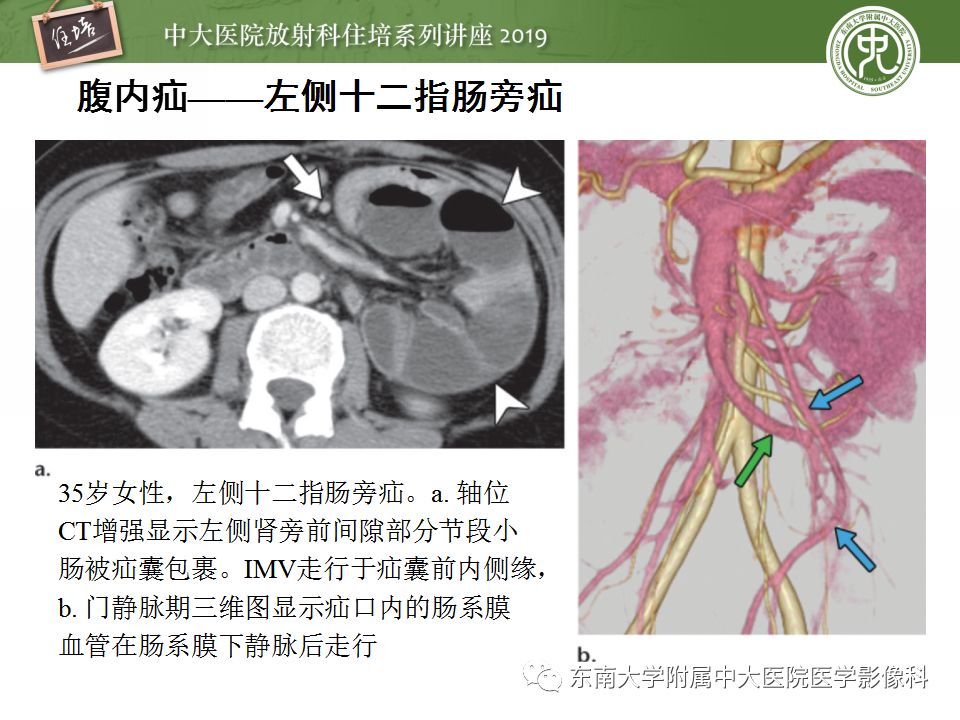 【PPT】小肠梗阻的影像分析及诊断