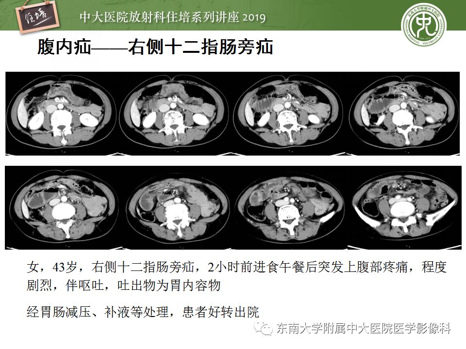 【PPT】小肠梗阻的影像分析及诊断