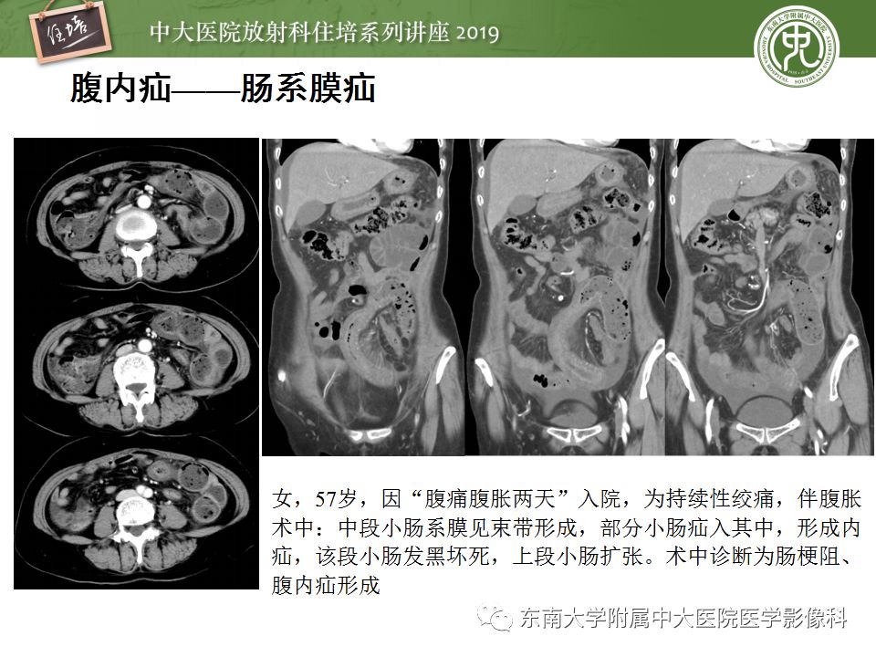 【PPT】小肠梗阻的影像分析及诊断