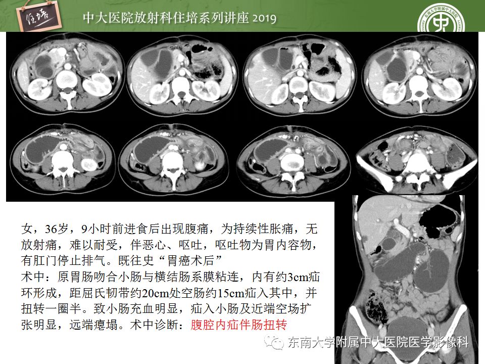 【PPT】小肠梗阻的影像分析及诊断