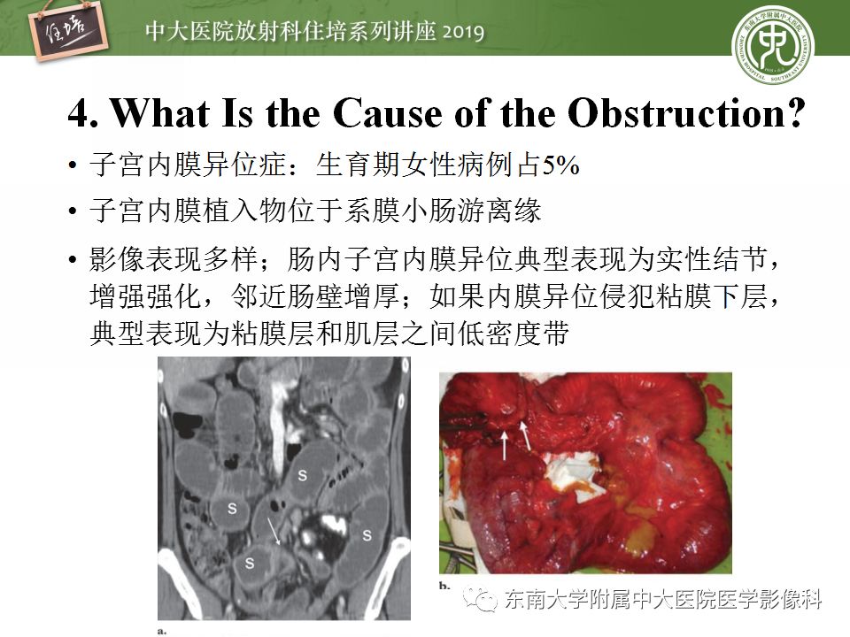 【PPT】小肠梗阻的影像分析及诊断