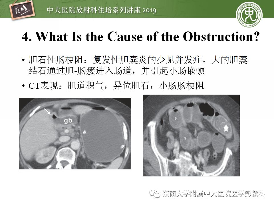 【PPT】小肠梗阻的影像分析及诊断