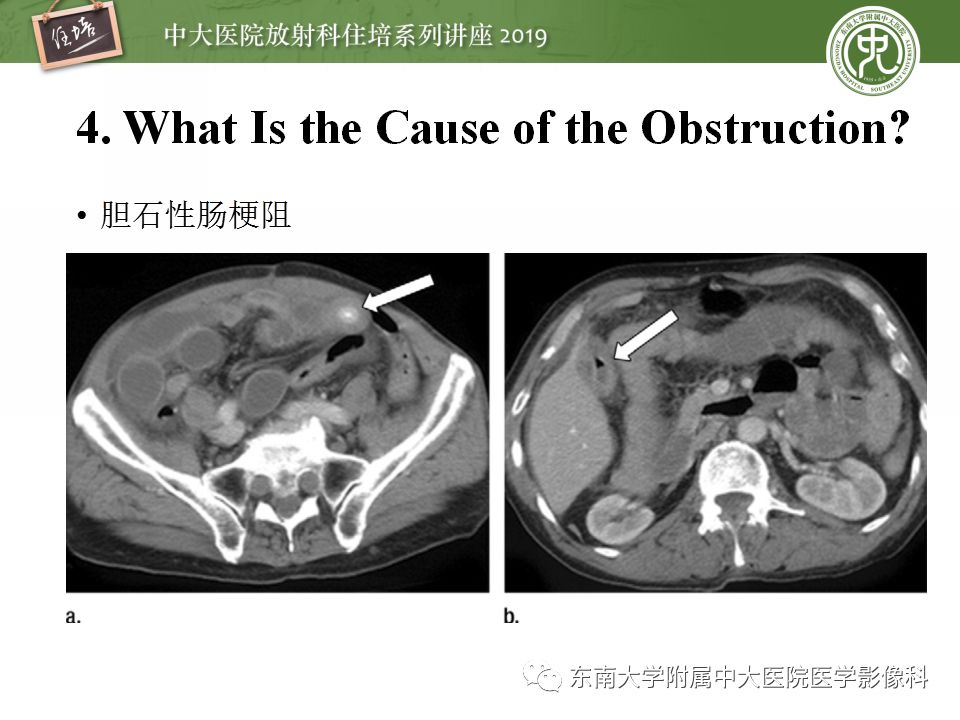 【PPT】小肠梗阻的影像分析及诊断