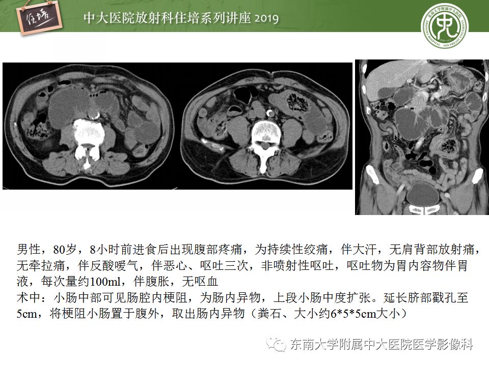 【PPT】小肠梗阻的影像分析及诊断