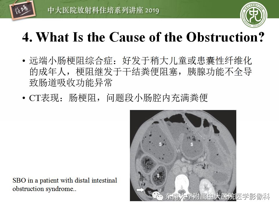 【PPT】小肠梗阻的影像分析及诊断