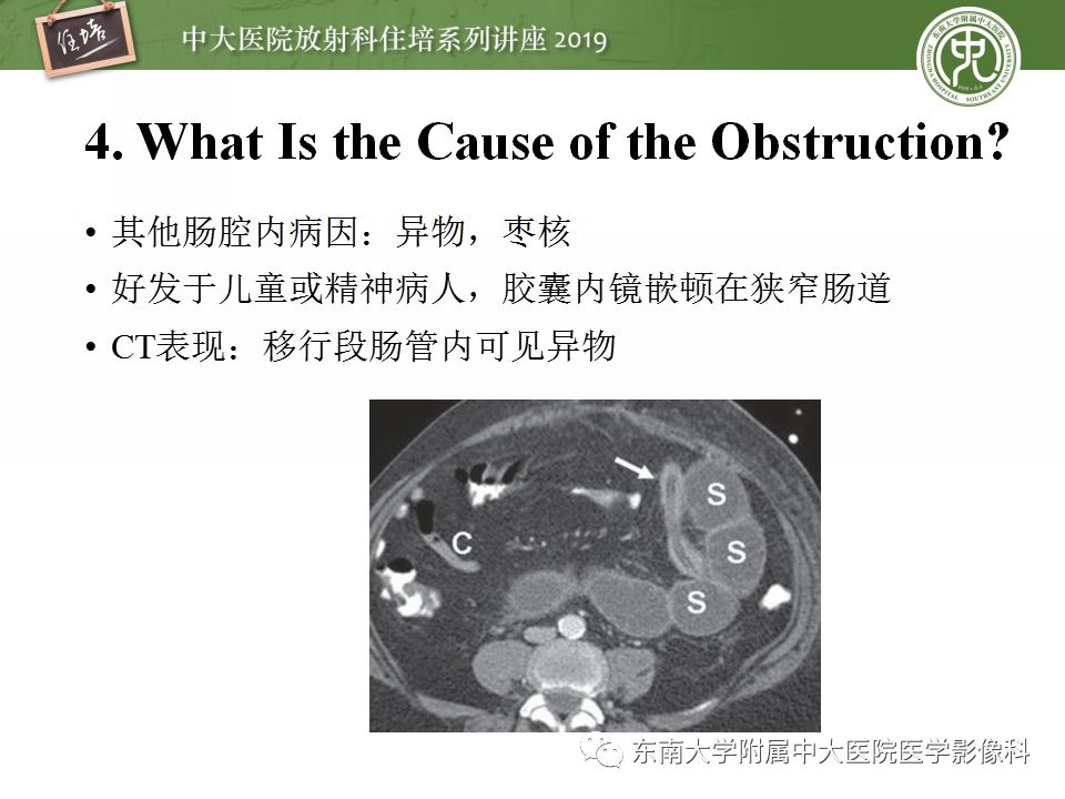 【PPT】小肠梗阻的影像分析及诊断