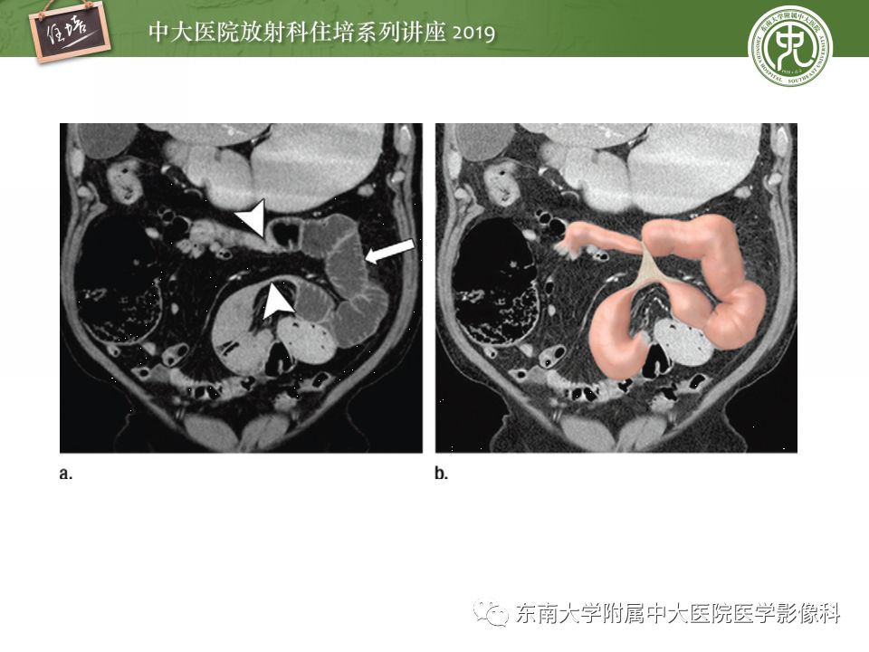 【PPT】小肠梗阻的影像分析及诊断