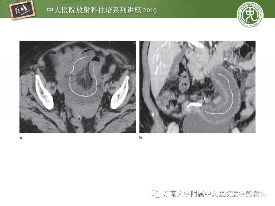 【PPT】小肠梗阻的影像分析及诊断