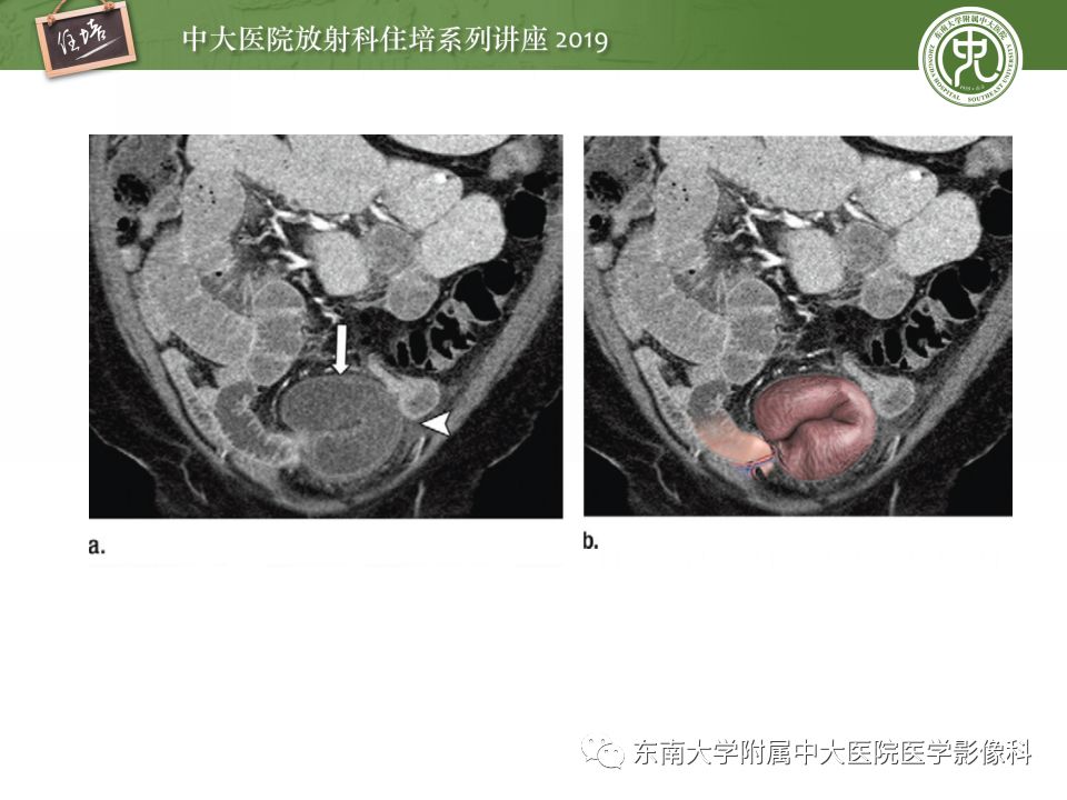 【PPT】小肠梗阻的影像分析及诊断