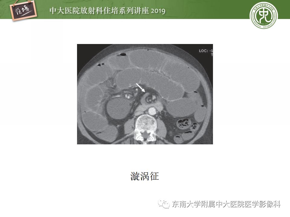 【PPT】小肠梗阻的影像分析及诊断