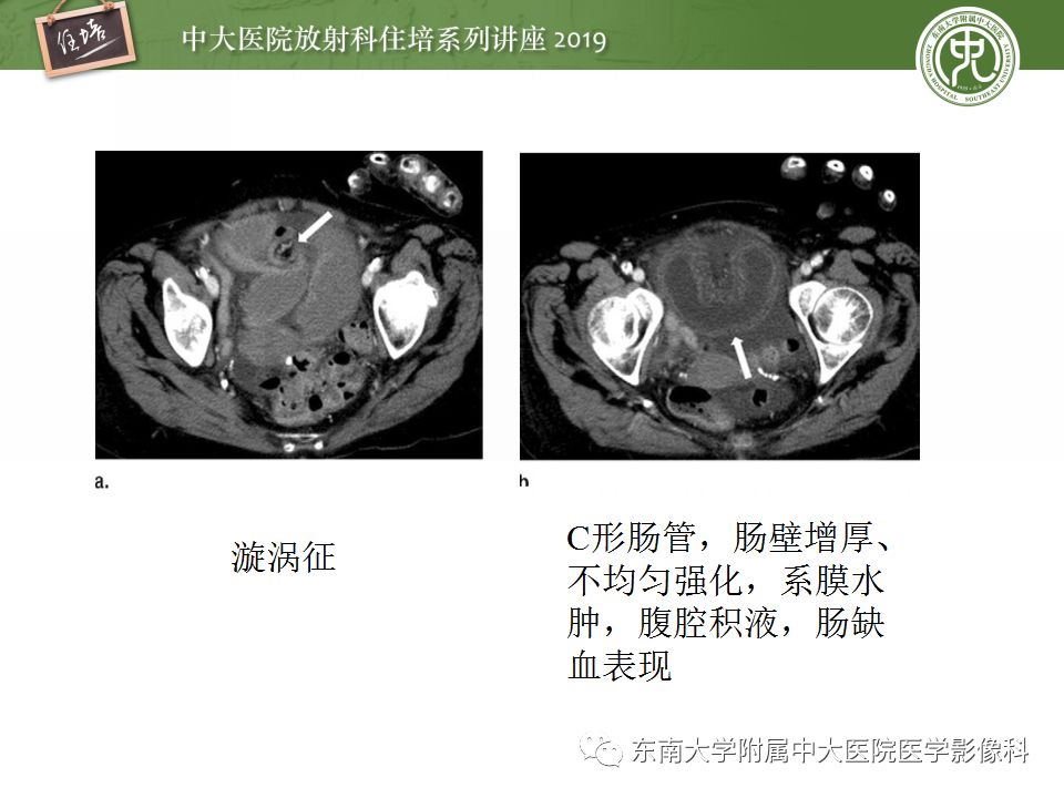 【PPT】小肠梗阻的影像分析及诊断