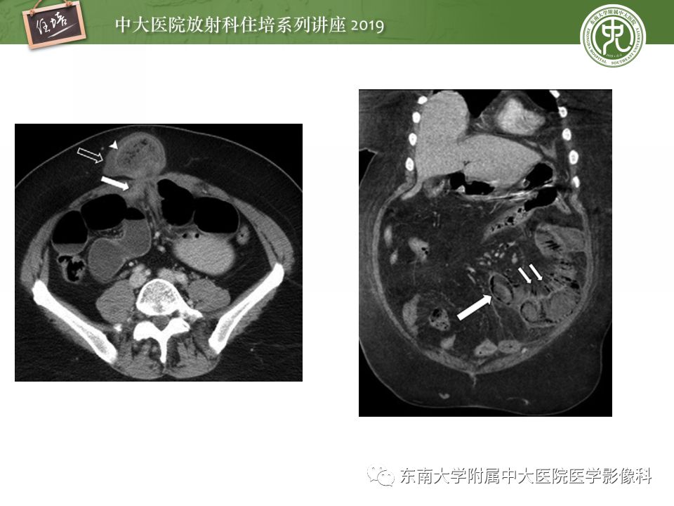 【PPT】小肠梗阻的影像分析及诊断